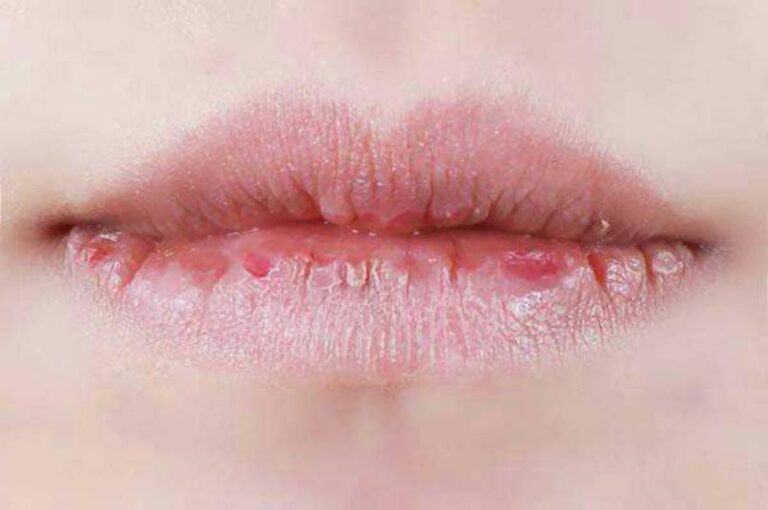 Heal Chapped Lips using Home Remedy - Reader Wiz